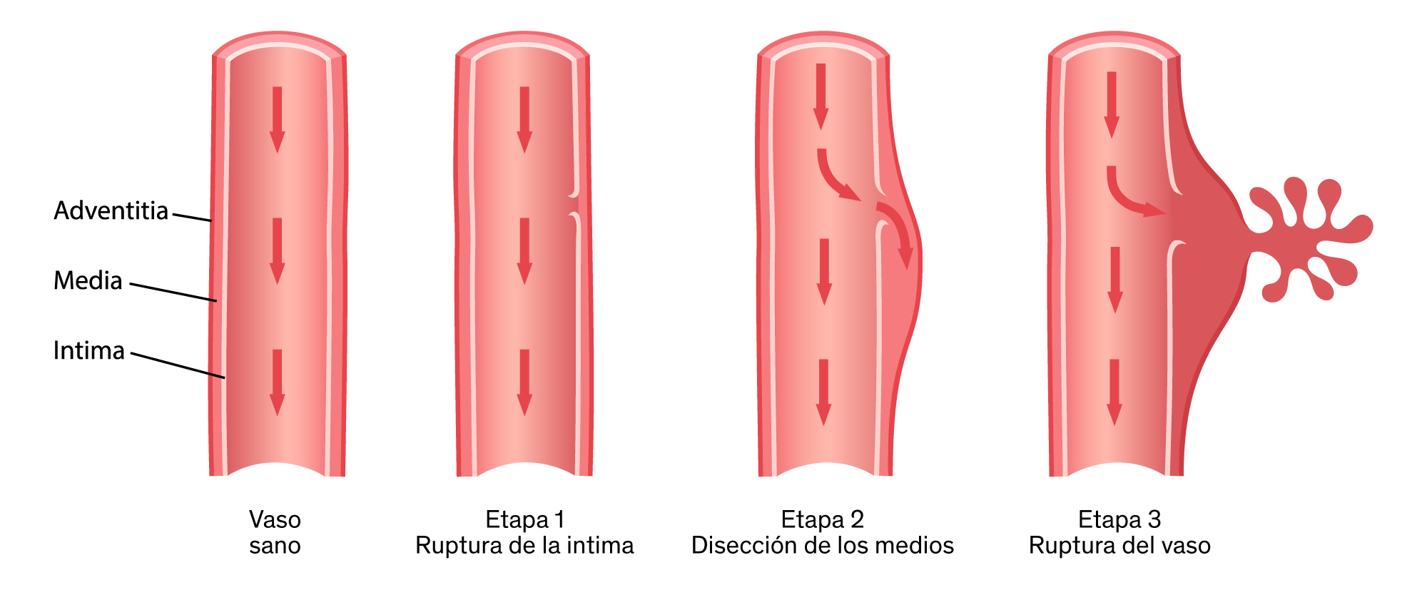 Diagrama diseccion aortica