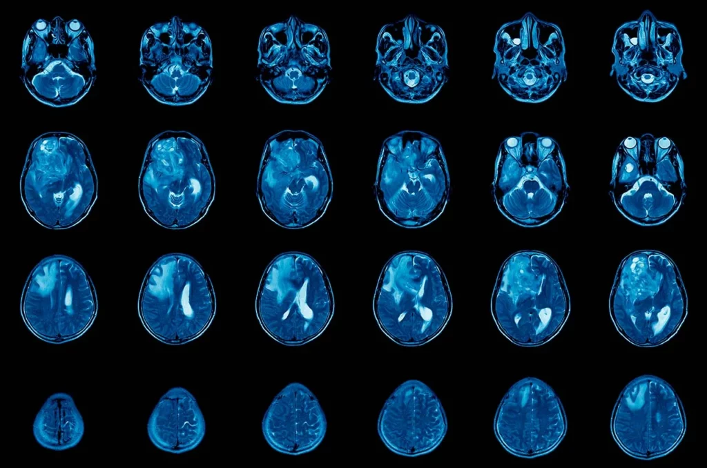 Imágenes de resonancia magnética de un cerebro para analizar la presencia de un glioma multiforme. 